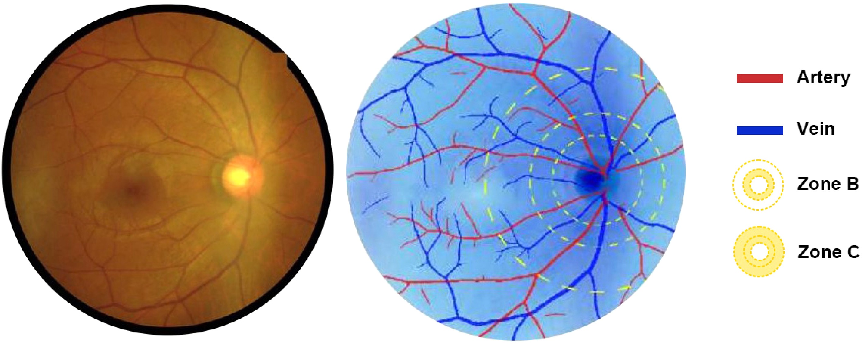 Relationship between systemic indicators and retinal vessel caliber in ...